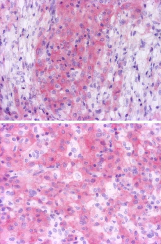 Figure 1. Identification of cells with BRAF mutation. Immunohistochemistry with BRAFV600E specific antibody VE1 disclosed cytoplasmic staining of histiocytes, whereas lymphocytes and fibroblasts were negative (top, original magnification ×100). Some histiocytes were not stained and correspond to reactive macrophages (bottom, original magnification ×200). Microphotographs were performed with a microscope BX41, eyepiece (WH 10×/22), objectives Olympus UPlanFI 10× and Olympus UPlanFI 20× (Olympus), Camera Axopcam ICc1, and AxioVision Rel Version 4.8 software (Carl Zeiss).