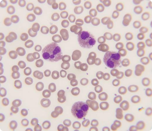 A 76-year-old female with chronic renal disease and dementia was admitted for acute chest pain. Physical examination showed no skin rash or wheezing. A CT scan for pulmonary embolism was positive and anticoagulation was started. Her blood tests showed white blood cells of 21.9 × 109/L, hemoglobin 10.2 g/dL, and platelets 308 × 109/L. The peripheral blood smear showed marked eosinophilia at 60% (see figure) and the red cells and platelets were normal. A bone marrow evaluation demonstrated 31% mature eosinophils without marrow dyspoietic changes. The FIP1L1-PDGFR fusion gene mutation was not present and the chromosomes showed a normal female karyotype. Two years later she was readmitted for worsening dementia and kidney failure. At that time laboratory testing showed normal white blood cells and no evidence of eosinophilia. / The presence of eosinophilia raises a number of clinical etiologic possibilities, including connective tissue disease, allergies, recent travel, parasitic infections, lymphomas, myeloproliferative disease, and drug reactions. None of these disorders had been present in this patient, but she had eosinophilia at a time when pulmonary embolization was present. An association between eosinophilia and thrombosis and/or embolization has been reported. Eosinophilia occurs in a number of pathophysiologic processes that involve the lung. The relationship between eosinophils and the clotting system is less well understood.