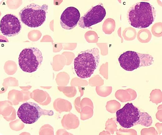 An 81-year-old man had multiple skin lesions (brown-red plaques on the face, abdomen, and back) and asthenia. There was no hepatosplenomegaly or adenopathy. Despite normal blood count values, the peripheral smear contained blasts (7%). Bone marrow examination showed 50% of blasts and mild erythroid dysplasia. The abnormal cells were medium-sized with blastic round (panels A-B) or convoluted (panels C-D,H) nuclei, fine to slightly condensed chromatin, and variable nucleoli. Some blasts had a pseudolymphoid appearance (panel B). The cytoplasm had faint heterogeneous basophilia, no granulation, and peripherally located vacuoles (panels A-F). Occasional cells with pseudopodia were present (panels F-H). Myeloperoxidase and butyrate esterase was negative. Flow cytometry showed a CD45low population expressing CD4, CD56, CD303, CD304, and high levels of CD123 and TCL1. There was no T-cell, B-cell or myeloid expression except for CD33 and CD2, and no expression of CD34 or Tdt. Karyotype was normal. A diagnosis of blastic plasmacytoid dendritic cell neoplasm (BPDCN) was made. A course of chemotherapy led to a short cutaneous remission, but he relapsed and died 7 months later. / BPDCN is an aggressive hematologic malignancy that involves precursors of plasmacytoid dendritic cells. The cells involve the skin and disseminate rapidly. Most patients are elderly with a male predominance. Despite responses to chemotherapy, the medial survival is short.