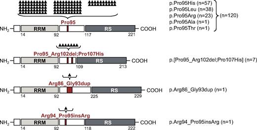 Figure 1. Schematic overview of SRSF2 protein organization, mutation type, and mutation frequency. SRSF2 consists of an RRM (AA 14-92; light gray box), a linker region (white box), and an RS-rich domain (AA 117-221; dark gray box). The 4 different mutation types and their mutation localization are indicated in red. The mutation frequency is listed and also shown as black triangles above each mutation type. Each triangle is representing 1 mutated case. From top to bottom, Pro95 missense mutations, p.Pro95_Arg102del;Pro107His, p.Arg86_Gly93dup, and p.Arg94_Pro95insArg alterations are depicted.