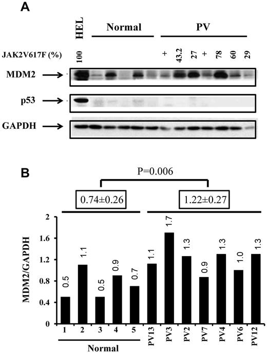 Figure 1. PV CD34+ cells contained higher levels of MDM2 protein. (A) Western blotting demonstrated the increased expression of MDM2 and lower levels of p53 in PV CD34+ cells (7 PVs and 5 normal BMs). (B) The quantification of protein levels was performed densitometrically and normalized to GAPDH levels.
