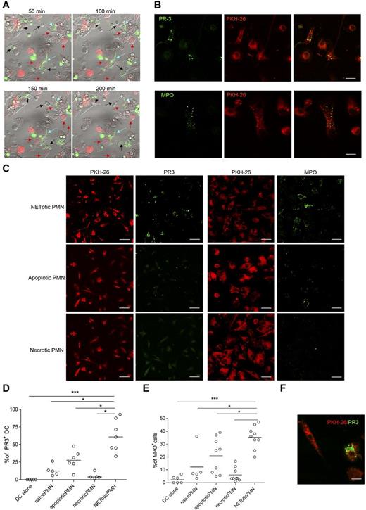 Figure 2. mDCs interact with NETotic PMNs and are loaded with proteins from NET. (A) NETs persistently interact with mDCs. In this live imaging experiment, agar-PMNs were seeded onto culture dishes and allowed to adhere 30 minutes before adding mDCs previously labeled with the membrane vital dye PKH-26. The cocultures were also performed in the presence of the DNA dye SYTOX green, which stains only PMNs undergoing NETosis. The coculture was maintained o/n in a humidified chamber under confocal microscope, acquiring a picture every 10 minutes to highlight any interaction between PMNs and mDCs. PMNs in the cellular mixture form NETs (turquoise arrows) and NETs interact with mDCs (red arrows). Black arrows indicate naive neutrophils. Scale bars represent 5 μm. (B) Uploading of mDCs with NET components. After NET interaction, mDCs are uploaded with the neutrophil protein PR3 and MPO. In this live imaging experiment, labeled PKH-26 mDCs were added to agar-PMN in the presence of a mAb to PR3 or MPO directly conjugated with Alexa-488 dye. After 18 hours, cells were fixed with PFA 4% and observed under a confocal microscope. Scale bars represent 10 μm. One representative experiment of 5 performed. (C) Uploading of PR3 and MPO by mDCs tested in the presence of different type of PMN death. Apoptotic PMNs, generated by Fas triggering Ab and necrotic PMNs obtained by freeze and thaw, were compared with NETotic PMNs for their capability to transfer PR3 and MPO to mDCs in coculture experiments. Representative confocal IF analysis showing that necrotic PMNs almost failed to transfer neutrophil PR3 or MPO to mDCs; on the contrary, PR3 and MPO were detectable as dotted green fluorescence in mDCs that interacted with NETotic PMNs and, to a lesser extent, in mDCs cultured with apoptotic PMNs. (D-E) Software-assisted micrograph quantification of mDCs uploading of PR3 (D) and MPO (E) performed on a total of 200 cells that were imaged by confocal microscopy. DCs cultured with naive PMNs, maintained alive by incubating them in the presence of 30% of FCS and DCs alone. were the negative controls for PR3 transfer and MPO. Scale bars represent 30 μm. (F) Appearance of PR3+ apoptotic bodies that are taken up by mDCs cocultured with apoptotic cells.