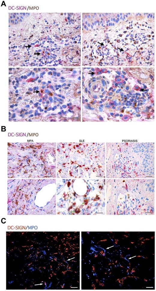 Figure 7. mDC-neutrophil interaction in skin biopsies from patients with MPO-ANCA–associated microscopic poliangiitis. (A) Double immunostaining with anti–DC-SIGN (purple) and anti-MPO (brown) shows mDCs intermingling with PMNs and populating the inflammatory infiltrate (top panels, black arrows; scale bars represent 25 μm). Higher magnifications highlight mDCs loaded with MPO (bottom panels, black arrows; scale bars represent 10 μm). (B) Within the inflammatory infiltrate involving dermal vessels of ANCA-associated MPA patients or in the skin of SLE patients, extracellularly located MPO, suggestive of NETs (black arrows), can be detected in close proximity with DC-SIGN+ cells (left panel, scale bar represents 25 μm; right panel, scale bar represents 10 μm). SLE skin biopsies also showed mDCs loaded with PMN apoptotic bodies (green arrows). On the other hand, in skin biopsies from psoriasis, DC-SIGN+ cells are not in contact with the few MPO+ cells that are present. (C) In situ immunofluorescence microscopy on the same samples highlighted the presence of NET (white arrows) in damaged areas as detected by DAPI nuclear staining (blue) and MPO (red; top panels). One representative biopsy from 1 of the 6 MPA patients analyzed is shown (original magnification ×40).