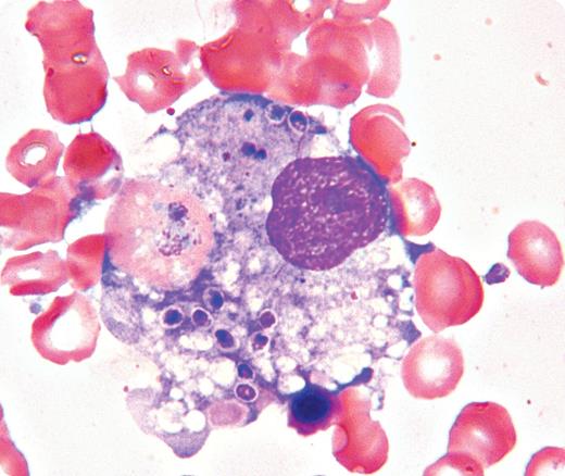 A 61-year-old truck driver developed a fever, cough, and shortness of breath requiring oxygen support and antibiotics. He had rheumatoid arthritis controlled with methotrexate and hydroxychloroquine. His occupation required delivering produce to and from the Mississippi River Valley to Ontario, Canada. His white blood cell count was 2.5 × 109/L, neutrophils 1.9 × 109/L, hemoglobin 98 g/L, and platelet count 30 × 109/L. Extensive lymphadenopathy and splenomegaly were noted. Ferritin was elevated, 2657 mcg/L, while triglycerides and coagulation tests were normal. Bone marrow examination showed numerous histiocytes with intracellular organisms (see figure). An intracellular red cell is also seen in this histiocyte. Special marrow stains along with marrow fungal cultures confirmed an underlying infection with Histoplasma capsulatum. / Histoplasma capsulatum is a fungus present in guano-contaminated soil and is common to the Mississippi River Valley. It can lead to a serious illness, especially in immunocompromised individuals. The occurrence of extensive phagocytosis has been reported in association with this infection and might be associated with pancytopenia. In this case, a number of causes of pancytopenia were investigated. However, the examination of the bone marrow provided the diagnosis and directed subsequent therapy. The patient responded rapidly to treatment with Amphotericin B and was discharged in stable condition.