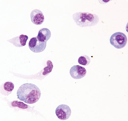 A 20-year-old woman with a history of intravenous drug use and previous methicillin-resistant Staphylococcus aureus (MRSA) endocarditis was admitted with a 1-week history of fever, headache, and confusion. Her cerebrospinal fluid (CSF) revealed 83 × 106/L nucleated cells with 61% neutrophils and 29% lymphocytes. CSF cultures grew MRSA. Antibiotics were started and an extraventricular drain was placed. One week later another lumbar puncture showed 440 × 106/L nucleated cells with 61% plasma cells, 28% lymphocytes, and 5% neutrophils. Numerous plasma cells were identified on a cytospin preparation (see figure). Peripheral blood neutrophilia (19.3 × 109/L) and normocytic anemia (hemoglobin 105 g/L) resolved at time of discharge. No serum protein electrophoresis was performed and there was no evidence of underlying malignancies or HIV. The patient recovered with only mild word-finding difficulties. / The presence of CSF plasmacytosis is unusual but nonspecific. It has been associated with central nervous system infections due to West Nile virus, HIV, herpes zoster virus, syphilis, Lyme disease, and tuberculosis. Other associations include multiple sclerosis and systemic hematologic malignancies such as multiple myeloma, and lymphoma. In this case, CSF plasmacytosis was associated with methicillin-resistant Staphylococcus aureus meningitis.