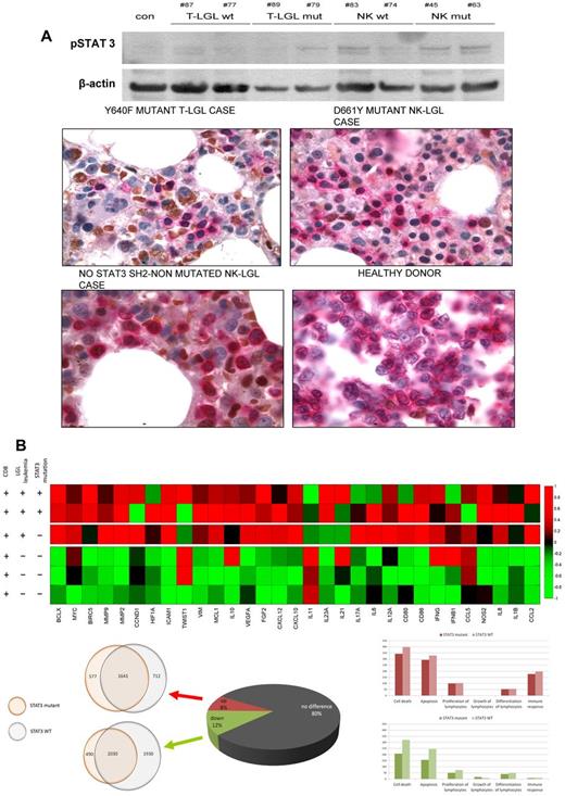 Figure 2. Proliferation and survival signals in chronic LGL diseases. (A) Constitutive STAT3 activation in leukemic cells. (Ai) Western blot analysis in leukemic cells from 4 T-LGL patients (2 mutated and 2 wild-type), 4 CLPD-NK patients (2 mutated and 2 wild-type), and a control. (Aii) Aberrant intracellular pSTAT3 signal (brown) has been also detected in paraffin sections from bone marrow biopsy samples of STAT3-mutant and nonmutant cases of T and NK origin. Previous immunohistochemical staining with CD8, surface CD3, and CD2 defined the cell lineage of the lymphocyte infiltration. Positive double staining with anticytoplasmic CD3 (pink) and pSTAT3 (brown) showed aberrant pSTAT3 signal in the infiltrating lymphoid compartment. Finally, a healthy donor tonsil sample shows no brown nuclei in cCD3-positive cells. (B) STAT3 pathway-related genes deregulated. (Bi) Heat map reflecting color-coded expression levels from a set of genes known to be regulated by STAT3 (columns) in purified T-LGL cells from 3 patients and control samples (rows). (Bii) Pie chart depicting whole genome expression in the 3 T-LGL leukemia patients and overlapping circles showing a high degree of coincidences in deregulated genes in mutated and nonmutated patients. (Ciii) Histograms of whole genome expression levels separated by pathways, exposing a predominance of deregulation in apoptosis and cell death, both in mutated and nonmutated patients. Up-regulated pathway genes are shown in pink (top panel) and down-regulated pathway genes in green (bottom panel).