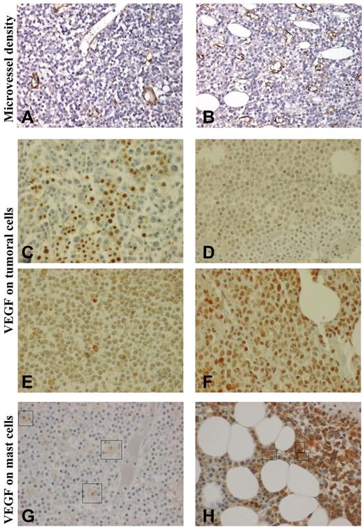 Figure 1. Immunohistochemistry in bone marrow biopsies. Microvessel density (MVD; Nikon Eclipse 80i and Sony DFW-X700 camera, ×400): (A): MVD graded 1 (slightly increased); (B) MVD graded 3 (markedly increased). Vascular endothelial growth factor (VEGF) expression (Olympus BX-51 microscope and DP50 camera, ×600) on bone marrow lymphoplasmacytic cells (LPCs): (C) strong staining on erythrocytes, no staining on LPCs; (D) grade 1 (weak) staining of 10%-50% of LPCs; (E) grade 2 (moderate) staining of more than 50% of LPCs; (F) grade 3 (strong) staining of more than 50% of LPCs. VEGF expression on mast cells: (G) weak staining (+) and (H) moderate staining (++). Because mast cells are rare and scattered compared with LPCs, they have been indicated by a box.