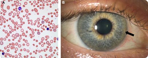 A 37-year-old woman with no previous medical problems noted malaise, jaundice, and dark urine that rapidly progressed to severe liver failure. She was referred for an evaluation of anemia. Her hemoglobin was 7.3 g/dL, reticulocyte count 132 000/μL, bilirubin 29.6 mg/dL, lactate dehydrogenase 1834 U/L, and alanine aminotransferase was normal. The blood smear revealed marked spherocytosis, “spur” cells, polychromasia, and nucleated red blood cells (panel A). The serum haptoglobin was undetectable and the direct antiglobulin (Coombs) test was negative. A serum ceruloplasmin was 20 mg/dL (normal, 18-54 mg/dL). The combination of the peripheral smear and evidence of hemolysis with liver failure made Wilson disease a strong consideration. An examination of her eyes revealed Kaiser-Fleischer (KF) rings. Emergency liver transplantation was performed. Her preoperative 24-hour urine later returned showing 2760 μg copper (normal, 3-50 μg). The explant contained copper 1440 μg/g dry weight (normal, 10-35 μg/g). Scleral icterus resolved after surgery. A photograph of the right eye (panel B) shows the KF ring. / During fulminant Wilson disease, nonceruloplasmin copper is abruptly released from the liver and may cause oxidative red cell damage and hemolysis. Short-term plasma exchange may ameliorate the hemolysis. Liver transplantation is preferred therapy because the allograft can produce the missing copper transport protein activity and may “cure” the disease. This patient had a full recovery.