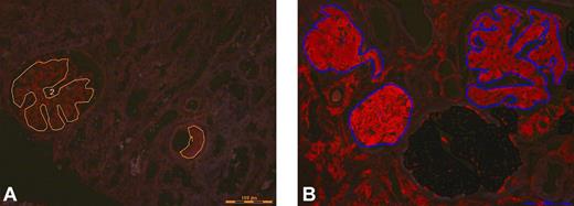 Figure 1. Laser microdissection. Congo red positive (A) glomeruli and vessels marked for microdissection from case 1 (AL with kappa light chain) and (B) glomeruli marked for microdissection from case 2 (ALECT2).