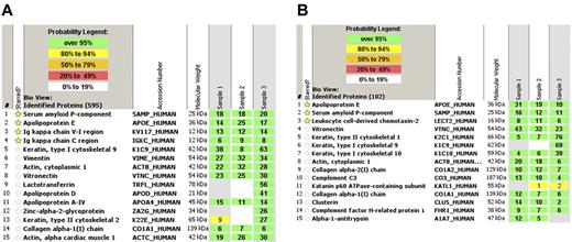 Figure 2. Representative mass spectrometry data. (A) AL κ light chain amyloidosis showing the top 15 spectra. Mass spectrometry shows large spectra for serum amyloid P-component, apolipoprotein E, and immunoglobulin κ V-I region and κ-constant region. (B) LECT-2 amyloidosis showing large spectra for serum amyloid P-component, apolipoprotein E, and leukocyte cell derived chemotaxin-2. The probability number (> 95% is highlighted by green, 80%-94% by yellow) indicates essentially the percent homology between peptides detected in the specimens and the published amino acid sequences of their corresponding proteins.