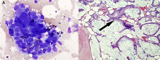 A 70-year-old man was being evaluated for back pain. Two years earlier he was found to have a monoclonal IgA λ protein (0.3 g/dL). Past history included long-standing history of ulcerative colitis with a partial colectomy and ileostomy 31 years earlier. A magnetic resonance imaging scan showed numerous destructive vertebral lesions. His complete blood count was normal except for a minimal normocytic normochromic anemia (hemoglobin 12.9 g/dL). Peripheral blood smear showed moderate anisopoikilocytosis without teardrop forms. Bone marrow biopsy and touch prep smears showed cohesive clusters of tumor cells (panel A). The marrow was replaced by mucin with occasional cellular groupings of colonic type glandular structures (panel B arrow). Immunostains were positive for cytokeratins as well as Cdx2, suggesting gastrointestinal origin, and a diagnosis of metastatic adenocarcinoma was made. Sigmoidoscopy revealed a large friable mass in the distal rectum and the biopsy showed invasive adenocarcinoma. / The clinical suspicion in this case was of myeloma, based on the radiologic findings and the previously known monoclonal protein. Colorectal cancer was unexpected, especially with the previous prophylactic partial colectomy. The bone marrow examination and endoscopy confirmed the metastatic adenocarcinoma.