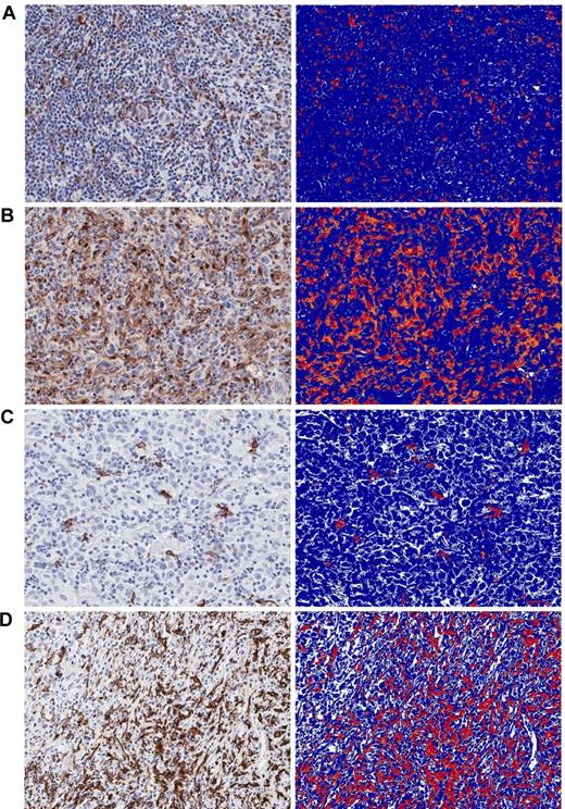 Figure 1. CD68 and CD163 IHC expression and accompanying computer image analysis (original magnification ×10). (A) CD68low, 4.2%. (B) CD68high, 19.5%. (C) CD163low, 1.8%. (D) CD163high, 26.9%.