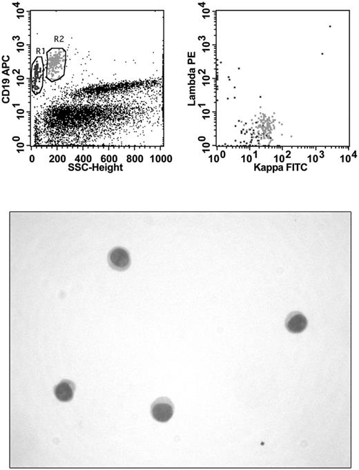 Figure 1. Immunophenotyping and CC in a patient with DLBCL. FCM analysis shows the presence of 2 B-cell populations: one (black) of small polyclonal B lymphocytes and another (gray) of large monoclonal (κ-light chain positive) neoplastic B cells. No evidence of malignancy can be seen in the hypocellular cytospin preparation.