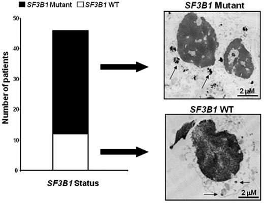 Figure 1. Mutations in SF3B1 are frequent in patients with RARS and RARS-T and lead to an alteration in the BM ultrastructure. Left panel: We performed Sanger sequencing on exons 13, 14, 15, and 16 of SF3B1 in 456 patients, finding that the frequency of SF3B1 mutations is higher in patients with RARS (68%) and RARS-T (81%) compared with the other groups. White bars and black bars represent WT and mutant RARS and RARS-T patients, respectively. Right panel: Transmission electron microscopy of BM cells from a representative WT and mutant RARS patient. Arrows indicate the presence of abundant perinuclear iron deposits in the mutant compared with the WT patient. Specimens' cuts are 2-μm-thick sections.