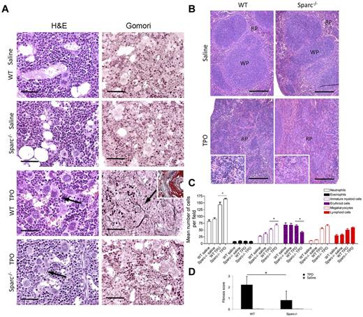 Figure 3. The development of TPO-induced experimental BM fibrosis in mice requires SPARC. WT and Sparc−/− mice were treated with recombinant TPO to induce myeloproliferation and fibrosis (n = 5 mice per condition, per experiment). Control mice were treated with the medium alone (sterile saline with 1% normal mouse serum). The data represent 1 experiment of the 3 performed. (A) Hematoxylin and eosin and Gomori staining of BM samples from TPO-treated WT and Sparc−/− mice. Hematoxylin and eosin staining shows that TPO administration induced granulocytic and megakaryocytic hyperplasia with MK atypia and cluster formation in both strains (hematoxylin and eosin panels, black arrows), which was not observed in sections from saline-treated mice. A significant degree of stromal fibrosis was observed in WT mice treated with TPO, which is highlighted by the presence of a network of black-stained fibers (Gomori panels, black arrow) and foci of osteosclerosis (Masson trichrome stain, inset). However, BM sections of TPO-treated Sparc−/− mice were completely free of signs of fibrosis similarly to the saline-treated WT and Sparc−/− mice (Gomori panels). Original magnifications ×400. Scale bars represent 50 μm. (B) Histopathologic analysis of the spleen architecture of control and TPO-treated WT and Sparc−/− mice showing that the splenic parenchyma of treated mice is characterized by effacement of the white pulp (WP) because of the expansion of the red pulp (RP) with prominent megakaryocytic hyperplasia and clustering (insets). Original magnifications ×100, insets ×200. Scale bars represent 200 μm. (C) Differential hematopoietic cell counts (mean ± SD) performed on BM sections of WT and Sparc−/− control and treated mice showing the significant increase in BM hematopoietic cells after TPO treatment. In each BM sample, the number of neutrophils, eosinophils, morphologically immature myeloid cells, erythroid cells, MKs, and lymphoid cells was counted of 10 HPFs. *P < .05. (D) Histopathologic grading of BM fibrosis in saline- and TPO-treated WT and Sparc−/− mice performed on Gomori-stained BM sections according to a 4-grade semiquantitative scoring system (see “Methods”). The mean grade of fibrosis is significantly higher in TPO-treated WT mice than in TPO-treated Sparc−/− mice. *P < .05.