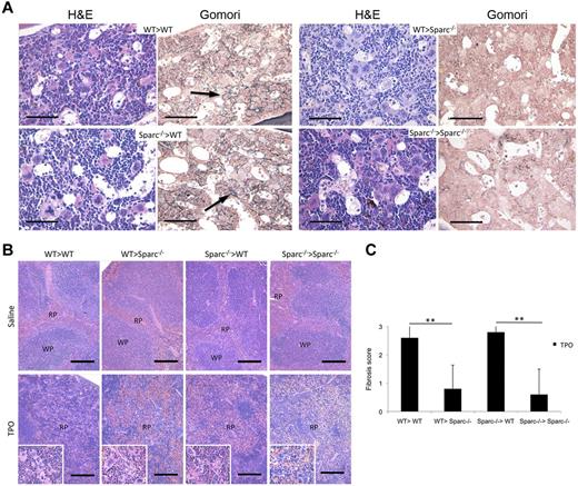 Figure 4. BM stromal cells are the relevant source of SPARC in the development of experimental BM fibrosis. BM chimeras were obtained by transplanting WT and Sparc−/− mice with either WT or Sparc−/− BM cells to obtain WT > WT, Sparc−/− > WT, WT > Sparc−/−, and Sparc−/− > Sparc−/− BM chimeras. Chimeras were treated with either recombinant TPO to induce myeloproliferation and fibrosis or medium alone as a control (n = 5 mice per group, per experiment). The data shown represent 1 experiment of the 3 performed. (A) Histopathologic analysis of BM samples from TPO-treated BM chimeras. Hematoxylin and eosin staining shows signs of myeloproliferation in all of the different types of BM chimeras, which include marked granulocytic and megakaryocytic hyperplasia with MK clustering (hematoxylin and eosin panels). A considerable degree of dysgranulopoiesis and megakaryocytic atypia is observed in chimeras with a Sparc−/− recipient (WT > Sparc−/−, Sparc−/− > Sparc−/−). Gomori staining shows a significant degree of stromal fibrosis only in BM chimeras in which the recipient is WT (WT > WT, Sparc−/− > WT), as highlighted by the presence of an intricate network of black-stained fibers (Gomori panels, black arrows). By contrast, no stromal fibrosis is detected in TPO-treated chimeras in which the recipient is Sparc−/−, irrespective of Sparc genotype of the donor. Original magnifications ×400. Scale bars represent 50 μm. (B) Histopathologic analysis of the splenic architecture of control and TPO-treated chimeric mice showing that the splenic parenchyma of treated mice is characterized by effacement of the white pulp (WP) because of the expansion of the red pulp (RP) with prominent megakaryocytic hyperplasia and clustering (insets). Original magnifications ×100, insets ×200. Scale bars represent 200 μm. (C) Grading of BM fibrosis in TPO-treated BM chimeric mice was performed on Gomori-stained BM sections according to a 4-grade semiquantitative scoring system (see “Histopathology and immunohistochemistry”). The mean grade of fibrosis is significantly higher in TPO-treated chimeric mice with a WT recipient than in those with Sparc−/− recipients. **P < .01.