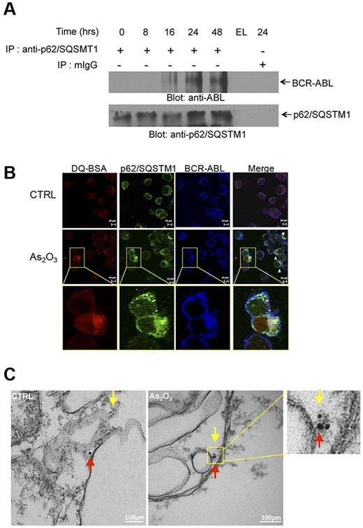 Figure 3. Lysosomal colocalization of BCR-ABL and p62/SQSTM1. (A) K562 cells were incubated in the presence of As2O3 for the indicated times. Cells were lysed and lysates were immunoprecipitated (IP) with an anti-p62/SQSTM1 antibody or control normal mouse IgG (mIgG), as indicated. EL indicates an empty lane. Immunoprecipitated proteins were resolved by SDS-PAGE and immunoblotted with anti-ABL or anti-p62/SQSTM1 antibodies, as indicate. (B) K562 cells were treated with As2O3 (2μM) for 24 hours. Before collection, cells were stained with quenched probe DQ-BSA (red), and after collection stained with either anti-ABL (blue) or anti-p62/SQSTM1 (green) and signals were detected by confocal microscopy. Merged panels indicate overlapping images of the 3 fluorescing signals, and arrows show the colocalization of p62/SQSTM1, BCR-ABL and lysosomal probe DQ-BSA. (C) As2O3–dependent colocalization of BCR-ABL with p62/SQSTM1, detected by electron microscopy. K562 cells were treated for 16 hours with AS2O3 (2μM) and were subsequently processed as described in “Electron microscopy.” Red arrows indicate BCR-ABL (15 nm gold-conjugate) and yellow arrows indicate p62 (6 nm gold-conjugate).