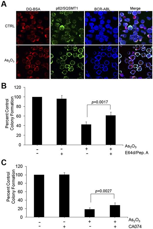 Figure 5. Autophagic degradation of BCR-ABL contributes to the generation of the antileukemic effects of As2O3 on primitive leukemic progenitors from CML patients. (A) Circulating leukemia cells from a CML patient were treated with As2O3 (2μM) for 24 hours. Before collection, cells were stained with quenched probe DQ-BSA (red), and after collection stained with either anti-ABL (blue) or anti-p62/SQSTM1 (green) as indicated, and signals were detected by confocal microscopy. Merged panels indicate overlapping images of the 3 fluorescing signals, and arrows show the colocalization of p62/SQSTM1, BCR-ABL, and lysosomal probe DQ-BSA. (B) Effects of As2O3 (0.5μM) or E64d/Pepstatin (10μM/10μM) or the indicated combinations on primitive leukemic progenitor (CFU-GM) colony formation from different CML patients were examined in clonogenic assays in methylcellulose. Data are expressed as percent control of CFU-GM colony numbers for control untreated cells and represent means ± SE of 6 independent experiments using samples from different patients. Paired t test analysis comparing the effects of As2O3 in the absence or presence of E64d/pepstatin demonstrated a paired value of P = .0017. (C) Effects of As2O3 (0.5μM) or CA-074 or the indicated combinations on primitive leukemic progenitor (CFU-GM) colony formation from different CML patients were examined in clonogenic assays in methylcellulose. Data are expressed as percent control of CFU-GM colony numbers for control untreated cells and represent means ± SE of 4 independent experiments using samples from different patients. Paired t test analysis comparing the effects of As2O3 in the absence or presence of E64d/pepstatin demonstrated a paired value of P = .0027.