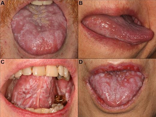 Figure 1. cGVHD lichenoid features of the tongue. Reticular cGVHD of the (A) tongue dorsum and (B) ventrolateral tongue demonstrating typical hyperkeratotic striations and plaque-like changes. More extensive involvement with heavy reticulation and associated ulcerations of the (C) ventral tongue and (D) tongue dorsum, with various degrees of erythema. There is prominent involvement of the lips in panel D, which stops abruptly at the vermillion border.