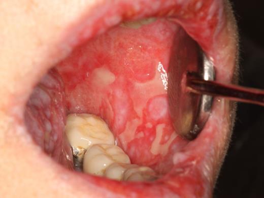 Figure 2. cGVHD of the buccal mucosa with extensive multifocal areas of ulceration interspersed with erythema and reticulation.