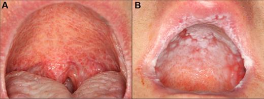 Figure 3. cGVHD affecting the palate. (A) Extensive reticulation of the entire hard and soft palate, extending to the uvula. (B) Hyperkeratotic involvement of the hard palate with associated erythema and focal areas of ulceration, with minimal soft palate extension. Note the heavy reticulation of the lips.