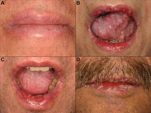 Figure 4. cGVHD of the lips. (A) Reticular changes only. (B-C) Extensive involvement with reticulation, erythema, and focal ulcerations. (D) Heavy scaling and painful peeling of the lips.