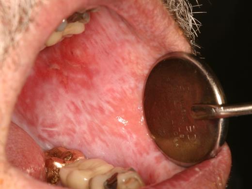 Figure 5. cGVHD of the buccal mucosa with extensive and thick hyperkeratosis making the mouth feel “tight” with limited opening.