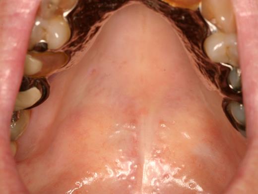 Figure 6. Salivary gland cGVHD with desiccated appearing palatal mucosa secondary to severe salivary gland hypofunction.