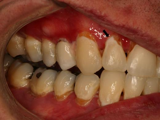 Figure 7. Rampant cervical dental caries affecting all of the teeth in a patient with cGVHD of the salivary glands. Demineralization changes (arrow) appear chalky white.