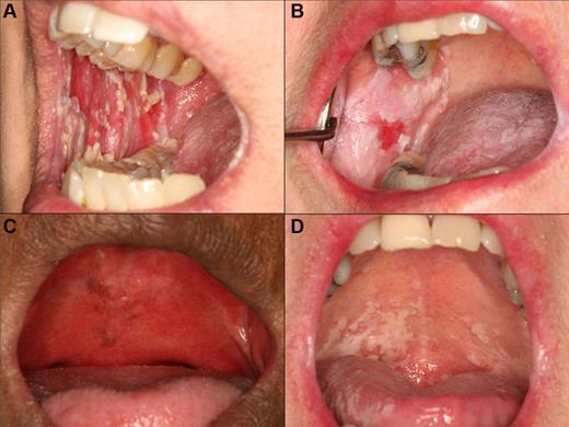 Figure 8. Oral candidiasis in patients with oral cGVHD. (A) Florid pseudomembranous candidiasis in a patient using intensive topical clobetasol solution rinses. (B) Thick, plaque-like confluent pseudomembranous candidiasis in a patient using combined clobetasol and tacrolimus solutions. (C) Erythematous candidiasis in a patient with severe cGVHD-associated salivary gland hypofunction and a full maxillary denture. (D) Typical patchy pseudomembranous candidiasis of the palate in a patient rinsing with dexamethasone solution.