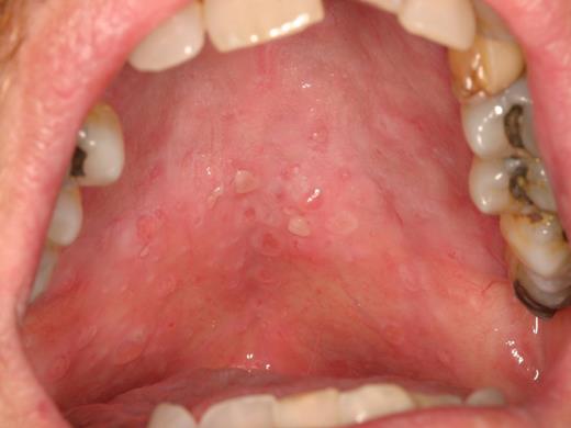 Figure 9. Multiple superficial mucoceles of the palate.