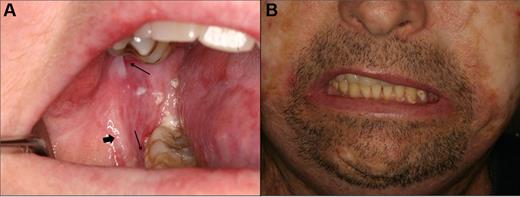 Figure 10. Orofacial sclerotic cGVHD. (A) Fibrous band formation of the right buccal mucosa secondary to longstanding mucosal cGVHD, with limited opening and secondary gingival injury because of tightness. (B) Generalized skin and myofascial fibrosis with intense and painful secondary myospasms and limited opening.