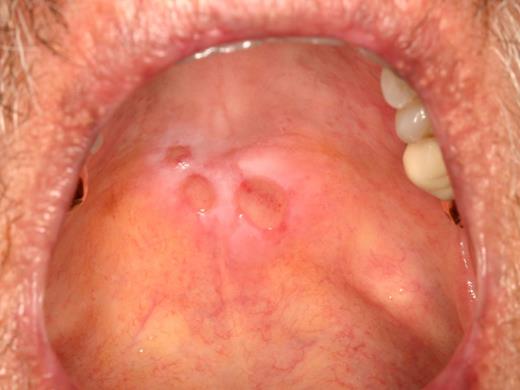 Figure 11. Recrudescent herpes simplex virus infection of the hard palate with 3 distinct, clustered ulcerations in a patient with a prior history of, but not currently active, oral cGVHD.