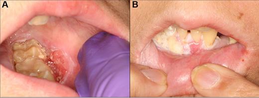 Figure 12. Squamous cell carcinoma of the left posterior buccal vestibule in a 14-year-old girl that was 6 years after transplantation, with a prior history of severe mucosal cGVHD. (A) Ulcerated, exophytic, and indurated lesion of the vestibule that was treated with wide excision and chemoradiation therapy. (B) Localized recurrence that was evident within weeks of completion of therapy.