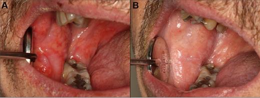 Figure 13. Management of oral cGVHD with compounded topical clobetasol solution therapy. (A) Extensive ulcerations of the right buccal mucosa. (B) Nearly complete resolution with only residual reticulation and complete symptomatic response after 1 month of intensive topical therapy, with no change in systemic immunosuppression.