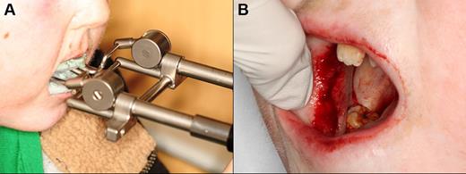 Figure 14. Eleven-year-old patient with severe trismus secondary to cGVHD-associated mucosal fibrosis. (A) Using the Dynasplint jaw rehabilitation device to improve maximum opening. (B) Undergoing surgical band-release procedure in an attempt to further improve mouth opening.