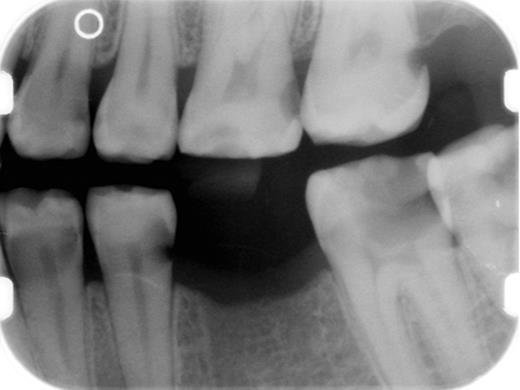 Figure 15. Intaoral bitewing radiograph demonstrating multiple interproximal dental caries (radiolucencies) in a patient with salivary gland chronic GVHD.