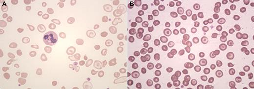 A 21-year-old woman presented with severe anemia and mild splenomegaly. Her complete blood cell count revealed a hemoglobin of 60 g/L, red cell count 2.8 × 1012/L, hematocrit 32%, MCV 114 fL, and MCH 21.4 pg. The reticulocyte count was 3.6%. The red cell indices suggested a macrocytic anemia. However, the peripheral smear (panel A) showed abundant macrocytic target cells, a few irregularly contracted red cells, polychromatophilia, macroovalocytes, and a few microcytes. In view of the target cells, high performance liquid chromatography was performed and a diagnosis of hemoglobin E disease was made. Her serum B12 level was 94 ng/L (normal range, 180-640 ng/L) with normal serum and red cell folate levels. A diagnosis of vitamin B12 deficiency with hemoglobin E disease was made. Her hemoglobin rose to 96 g/L after 2 weeks of supplementation of vitamin B12 and folate. / Hemoglobin E disease typically shows microcytic hypochromic anemia with target cells. The hematologic picture is best seen on this patient's follow-up peripheral smear (panel B). In this case, a vitamin B12 deficiency masked the underlying hemoglobinopathy, as determined by the automated cell counter. Other red cell abnormalities, such as thalassemia, may also be missed without a review of the peripheral smear.