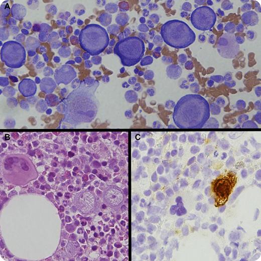 A 29-year-old female presented with unexplained anemia (hemoglobin 77 g/L) 5 years after orthoptic heart transplantation. She was being treated with high-dose immunosuppression. The blood film demonstrated a normochromic normocytic anemia. The white cell and platelet counts were normal. There was reticulocytopenia (1 × 109/L, 0.04%) and an elevated erythropoietin (356 U/mL; normal, 5-18.5 U/mL) with normal B12, folate, and iron studies. No evidence of thymoma or lymphoma was found as judged by radiologic testing and flow cytometry. A bone marrow examination showed atypical giant pronormoblasts with markedly reduced maturing granulopoiesis (panels A and B) that was characteristic of parvovirus-induced pure red cell aplasia. Adjacent megakaryocytes demonstrate the relative size of the atypical giant pronormoblasts in panel B. Immunohistochemistry for parvovirus B19 was positive on the marrow biopsy (panel C). Parvovirus B19 DNA was detected by PCR; however, serology (IgM/IgG) was negative. Treatment with intravenous immunoglobulin (1 g/kg) followed by monthly maintenance dosing (0.4 g/kg) has ameliorated her anemia. / Despite strong clinical suspicion of parvovirus infection in this immunocompromised patient, serologic testing was negative. The characteristic bone marrow examination findings and PCR testing were required to confirm the diagnosis. This case highlights the limited utility of parvovirus serology in immunocompromised patients.