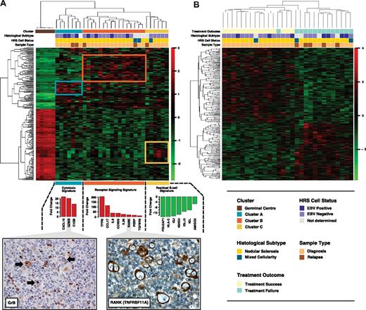 Figure 1. Expression profiling of 29 samples of microdissected HRS cells. (A) Unsupervised hierarchical cluster of 29 gene expression profiles is shown using the 200 genes with the highest variance. Red represents relative overexpression; and green, relative underexpression. Patient clusters, histologic subtype, EBV positivity of HRS cells by for EBV-encoded small RNA in situ hybridization, and sample type are shown. The average fold changes of genes representative of the 3 main signatures are shown in the bar plots. Representative immunohistochemistry images are depicted demonstrating cytoplasmic positivity of GrB (black arrows) and RANK in HRS cells. (B) Unsupervised hierarchical clustering of the cohort using the 200 most differentially expressed genes between primary treatment failure and success. Treatment outcome, histologic subtype, EBV positivity of HRS cells by for EBV-encoded small RNA in situ hybridization, and sample type are shown. Cases cluster according to the outcome groups (2 main clusters). Differentially expressed genes are given in the supplementary data (comparison gene lists).