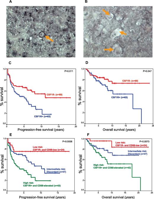 Figure 3. mRNA in situ hybridization in HRS cells identifies patients with inferior PFS and OS in an independent validation cohort (n = 132). (A) A representative CSF1R-positive case is shown highlighting cytoplasmic positivity in a Hodgkin cell (orange arrow) and macrophages in the reactive infiltrate. (B) A representative CSF1R-negative case is shown with no staining in the multinucleated HRS cells (orange arrows). (C) PFS according to CSF1R mRNA in situ hybridization. (D) OS according to CSF1R mRNA in situ hybridization. (E) PFS according to a combined CD68 IHC/CSF1R in situ hybridization score. (F) OS according to a combined CD68 IHC/CSF1R in situ hybridization score.