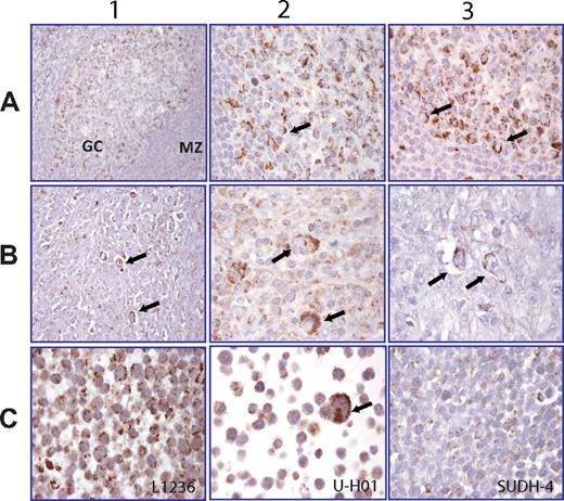 Figure 3. Stable NIK expression can be detected in both HL cell lines and primary HL biopsies. (A) Row 1: Normal human tonsil. NIK expression is restricted to the germinal center (GC), particularly centroblasts appearing positive, whereas the mantle zone cells (MZ) are negative. Rows 2-3: High magnification of A1 showing a cytosolic granular staining in centroblasts. (B) Rows 1-3: Lymph node biopsies of 3 HL patients. Arrows indicate the granular cytosolic NIK staining in RS cells. (C) Rows 1-3: HL cell lines L1236 (C1) and U-H01 (C2) with NIK expression in the cytosol of tumor cells. (C3) SUDH-4, a DLBCL lymphoma cell line, is negative.