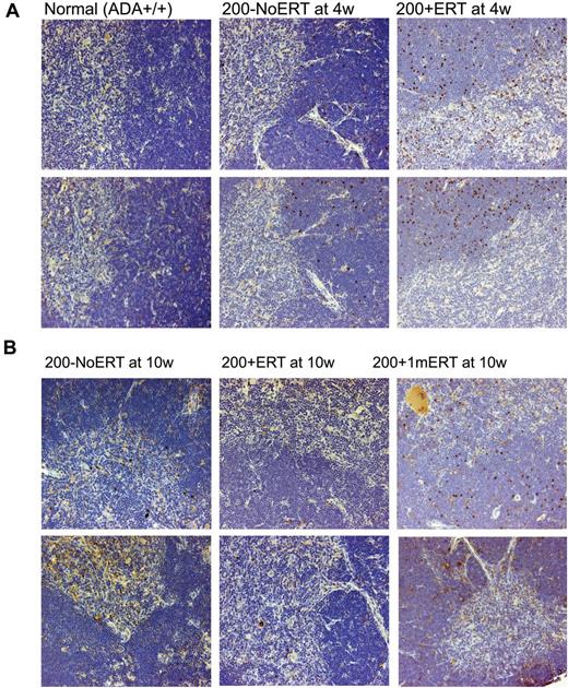Figure 4. Immunohistochemical analysis of thymus from ADA-deficient mice after GT with long- and short-term ERT. Perfused thymi were fixed, sectioned, and stained with antihuman ADA antibody (N-19; Santa Cruz Biotechnology) that was specific to human ADA and did not cross-react with murine ADA. Cells containing immune-reactive protein are stained brown. Micrographs of stained sections were made with an Olympus BX40 Microscope (Olympus America Inc) and an Olympus DP11 Camera (Olympus America Inc) All micrographs were made at room temperature, without the use of imaging medium, fluorochromes, or acquisition software. Magnification: (optical 10) total magnification ×200. (A) Thymi from 2 different normal control (Ada+/+) mice, ×200 + 1mERT, mice and 200−NoERT mice at 4 weeks. (B) Thymi from 2 different 200 + ERT mice, 200−NoERT mice, and 200 + 1mERT mice at 10 weeks.