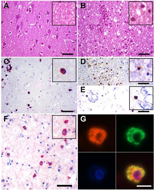 Figure 6. IL-17A is expressed by CD3+ T cells in human brain tissue shortly after stroke. H&E staining of unaffected brain tissue (A) and ischemic brain tissue 24 hours after stroke (B). The ischemic tissue was further analyzed by immunohistochemistry for the presence of neutrophils (MPO; C); T lymphocytes (CD3; D); γδ T cells (E), and IL-17A (F). (G) Double immunofluorescence analysis of CD3 (red) and IL-17A (green) at higher magnification. Scale bars = 50 μm (A-F) and 10 μm (G).