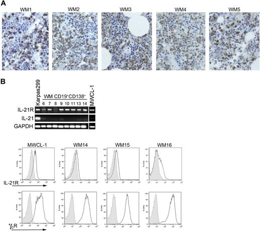 Figure 1. IL-21, IL-21R, and common γ chain receptor expression on WM cells. (A) Immunohistochemical staining of IL-21 (brown) in bone marrow sections obtained from 5 consenting patients with WM (WM1-WM5) was performed with a polyclonal anti–IL-21 antibody as described in “Methods.” Slides were visualized on an Olympic Provus AX70 light microscope, and images shown are with original magnification of ×400. (B) PCR for IL-21R, IL-21, and GADPH was performed on cDNA generated from either CD19+CD138+ cells obtained from patients with WM (n = 8; nos. 6-14) or the WM cell line, MWCL-1. RNA was extracted from previously frozen WM cells; therefore, the sample numbers are not consistent with those noted in other figures. The T-cell line Karpas299 was used as a positive control for both IL-21 and IL-21R. (C) IL-21R and common γ chain receptor coexpression was determined on CD19+CD138+ cells from patients with WM and the MWCL-1 cell line with the use of FACS analysis. Three representative histograms obtained from a total of 8 patient samples are shown (WM14-WM16). Gray histograms represent the appropriate isotype controls.