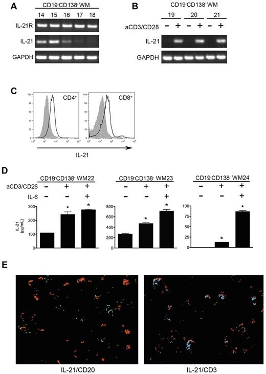 Figure 2. IL-21 in the WM bone marrow microenvironment is derived from activated T cells. (A) PCR for IL-21R, IL-21, and GAPDH was performed on cDNA generated from CD19−CD138− cells obtained from the bone marrows of patients with WM (n = 5; nos. 14-18). (B) Additional CD19−CD138− samples (n = 3; WM6-WM8) were cultured in the presence or absence of anti-CD3 and anti-CD28 for 72 hours to activate T cells. After total RNA extraction, RT-PCR was performed for IL-21 and GAPDH. (C) Flow cytometric analysis for intracellular IL-21 expression in CD19−CD138− WM cells. After culture of CD19−CD138− WM cells on plates coated with anti-CD3 in the presence of 1 μg/mL CD28 antibody for 96 hours, cells were stimulated with phorbol myristate acetate, ionomycin, and brefeldin A as described in “Methods.” To assess IL-21 expression in the activated T-cell population, we gated on the CD4+ and CD8+ populations separately. Shown are histograms representative of 3 different donors. Gray histograms are the respective isotype controls. (D) CD19−CD138− cells obtained from patients with WM (n = 3; WM22-WM24) were cultured for 96 hours in the absence or presence of anti-CD3, soluble CD28 antibody (1 μg/mL), or IL-6 (5 ng/mL) for 96 hours. Cell-free supernatants were collected, and the concentration of IL-21 was assessed by ELISA. All experiments were performed in triplicate, and data are represented as mean ± SD. *Statistically significant at P < .05. (E) Costaining of IL-21 with B cells (CD20) and T-cell (CD3) populations in WM bone marrow. Sections were first stained for IL-21 (red), stripped, and restained for either CD3 (blue) or CD20 (green). Digital images from each layer were then overlaid. A representative multicolor composite image is shown.