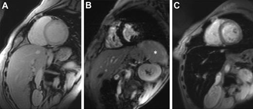 Figure 1. Cardiovascular magnetic resonance T2* images showing the heart and liver from 3 different patients at the same echo time (10.68 ms). (A) Normal appearance with a bright myocardial and liver signal indicating that there is no significant cardiac or hepatic iron loading (myocardial T2* 29 ms, liver T2* 22 ms). (B) Dark myocardial signal indicating severe myocardial siderosis (heart T2* 6.2 ms) but no liver iron (liver T2* 18 ms). *The spleen also has high signal, suggesting that there is no significant splenic iron loading. (C) Normal myocardial signal (heart T2* 24 ms) but dark liver consistent with severe hepatic iron overload (liver T2* 1.8 ms). Images courtesy of Dr J. P. Carpenter (The Royal Brompton Hospital, London, United Kingdom).
