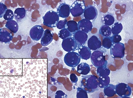 A 17-year-old female with history of a left cheek alveolar rhabdomyosarcoma (ARMS) status after 14 cycles of vincristine, dactinomycin, and cyclophosphamide presented 2 months after the last drug cycle with bruising, thrombocytopenia, and anemia (white blood cell count 3.4 × 109/L, hemoglobin 7.1 g/dL, platelets 8 × 109/L). The peripheral blood smear demonstrated normocytic anemia with nucleated red cells and teardrop cells, severe thrombocytopenia, and dysplastic granulocytes with a left shift (see figure insets). The bone marrow examination revealed blastlike cells of variable size with fine nuclear chromatin and prominent vacuoles within deep blue cytoplasm (see figure). The biopsy showed replacement by neoplastic cells, which were positive for desmin, myogenin, and CD56, but CD45-negative. Flow cytometry showed a CD45-negative, CD56-bright population. A diagnosis of metastatic ARMS was made. Cytogenetics demonstrated a complex karyotype, including t(2;13), and interphase FISH confirmed rearrangement involving FOXO1. / ARMS may mimic acute leukemia clinically, and the neoplastic cells can resemble hematologic blasts (especially lymphoblasts). This combination can result in a misdiagnosis. In this case, the peripheral smear and the clinical picture raised several possible causes. The diagnosis required correlation of a marrow examination, immunochemistry, flow cytometry, and cytogenetics.