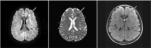 Figure 1. Axial MRI images of case 3. A 10-year-old girl with SCD and parvovirus infection with hgb = 2.9 g/dL showing (left, arrow) an area of restricted diffusion on DWI images with an ACD correlate (middle). Follow-up FLAIR MRI 7 months later (right) shows a lesion corresponding to the affected area on the DWI.