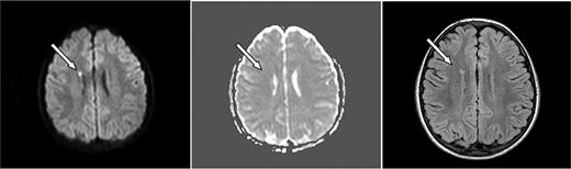 Figure 2. Axial MRI images of case 4. A 6-year-old boy with SCD and acute chest syndrome with hgb = 4.1 g/dL showing (left, arrow) an area of restricted diffusion on DWI images with an ADC correlate (middle). Follow-up FLAIR MRI 4 months later (right) shows a lesion corresponding to the affected area on the DWI.